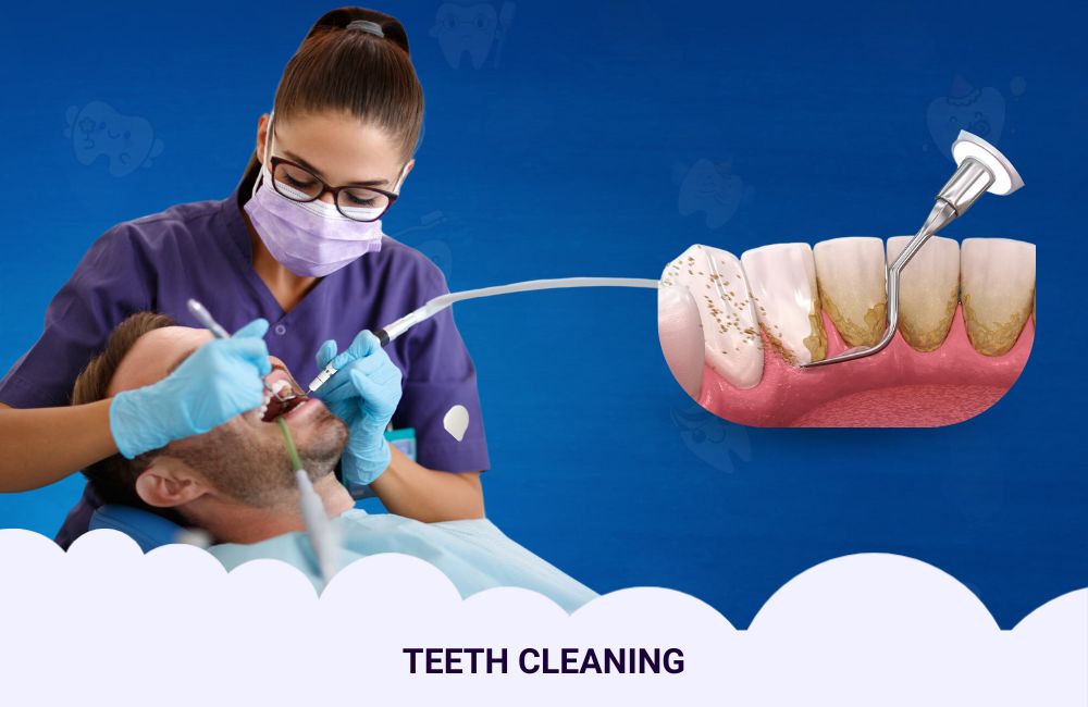 Teeth Cleaning In Ghodbunder Road